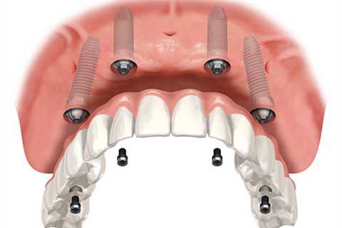 Bexley Dental: The Factors Behind The Cost Of The All On 4