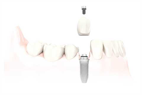 Cost Of Dental Implants Illustrated By ADG