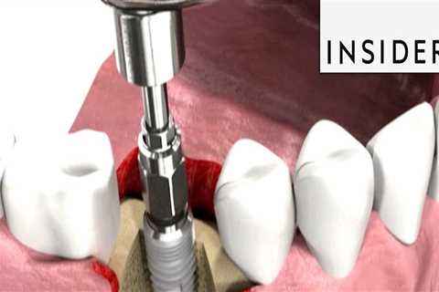 Do orthodontists insert implants?