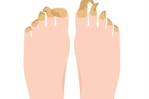 What Are the Common Causes of Thick Toenails?