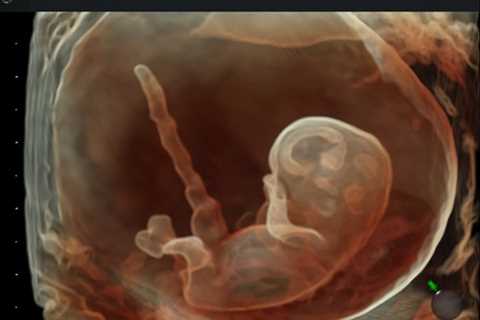 Enzyme Treatment Given To Fetus Prevents Debilitating Condition That Killed Siblings