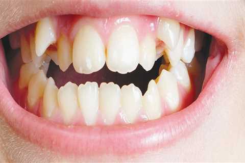 Mixed Dentition Period: When Primary and Permanent Teeth Coexist