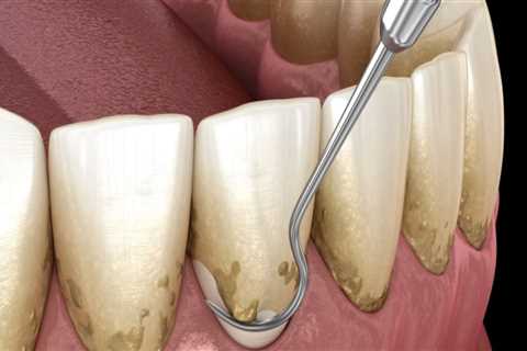 What Type of Dental Supplies are Used for Periodontal Treatments?