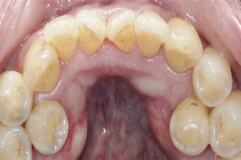 What are Bicuspid Teeth and How Do They Differ from Other Teeth?