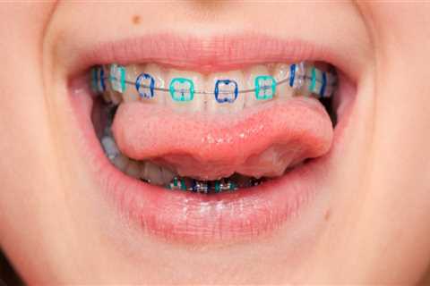 What Are the Special Considerations for Children with Braces at the Pediatric Dentist?