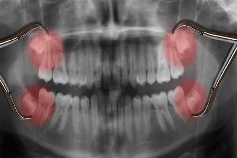 Potential Complications of Oral Surgery: What You Need to Know