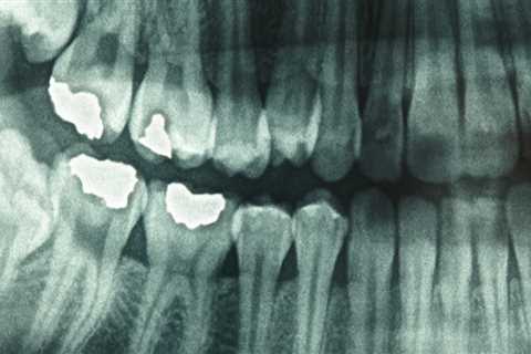 Safety Precautions for Dental X-Rays