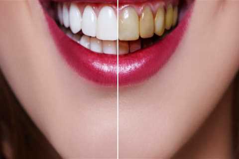 How Long Does Teeth Whitening Take to Work? A Comprehensive Guide