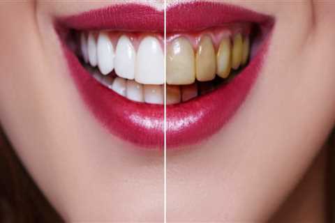 How Often Should You Get Your Teeth Professionally Whitened? A Professional's Guide