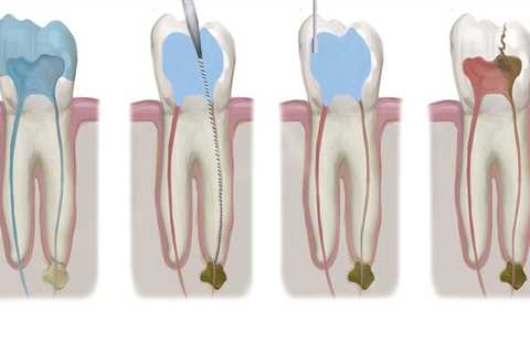 How Much Does Endodontic Treatment Cost? An Expert's Guide