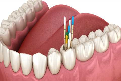 The Benefits of Endodontic Treatment: A Comprehensive Guide