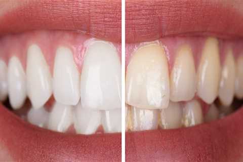 Does Age Affect Professional Teeth Whitening Results? - A Comprehensive Guide