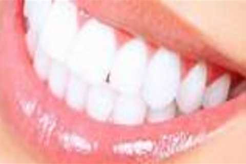 Choosing the Right Teeth Whitening Dentist in London: What You Need to Know