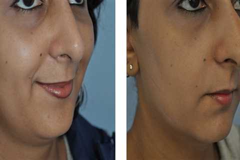 The Value Of A Health Consultant Before Undergoing Rhinoplasty Surgery In Seattle, WA