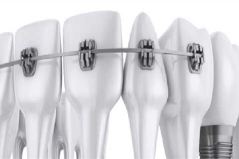 Are implants considered orthodontics?