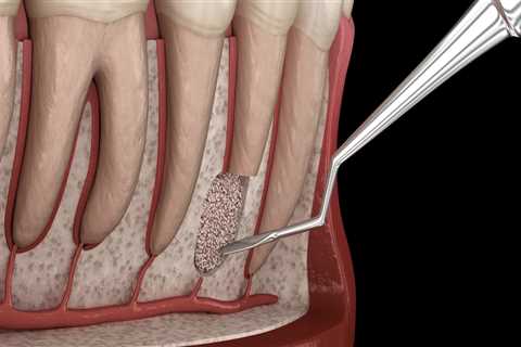 What is the Most Common Periodontal Surgery?