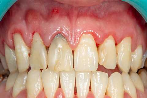 What are the Early Signs of Periodontal Disease?