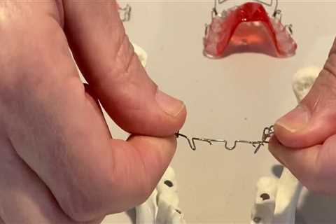 Why Orthodontists Don't Pull Teeth Anymore