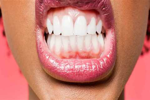 Gingivitis: What You Need to Know