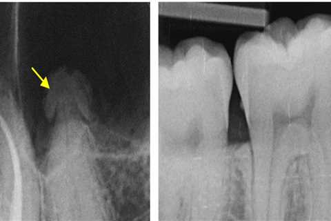 How Medical Imaging Enhances Root Canal Treatments In San Antonio