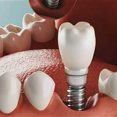 How Much Do Dental Implants Cost in Orange County, CA?