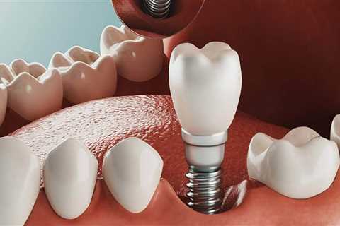 How Much Do Dental Implants Cost in Orange County, CA?