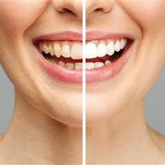 9 dicas para manter seus dentes brancos após o clareamento