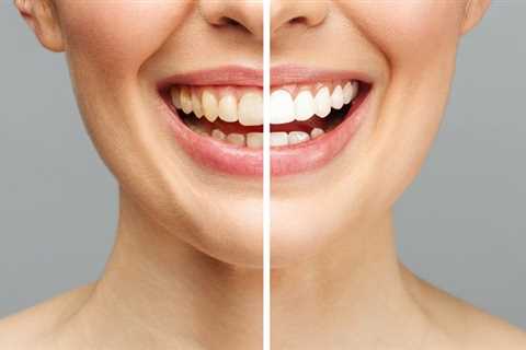 9 dicas para manter seus dentes brancos após o clareamento